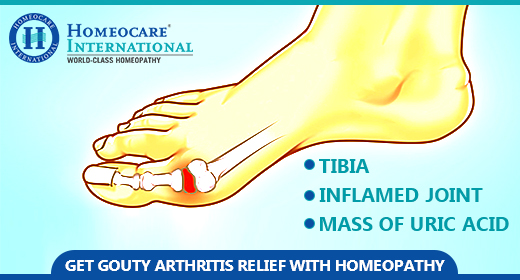 New approaches to treat Gouty Arthritis at Homeocare International ...